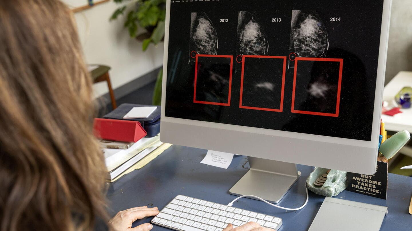 Hospitals Hesitate on Breast Cancer AI That Spots Tumors Years Before Radiologists