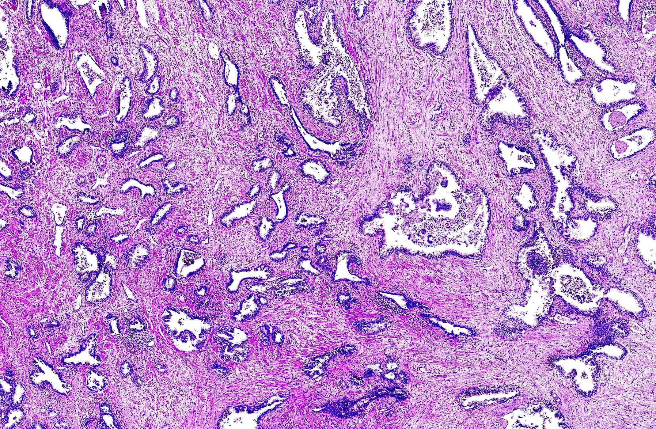 AI Pathology Tool Catches Diagnostic Errors in 5% of Prostate Biopsies in Major NHS Trial